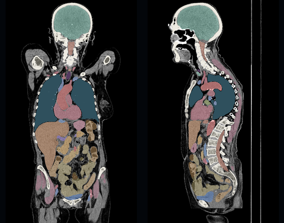 Coronal and sagittal body CT from head to upper femurs