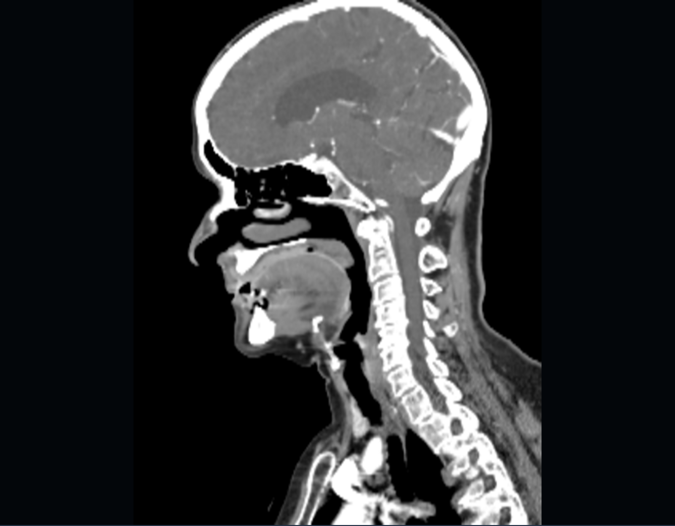 CT of the head showing the skull and brain