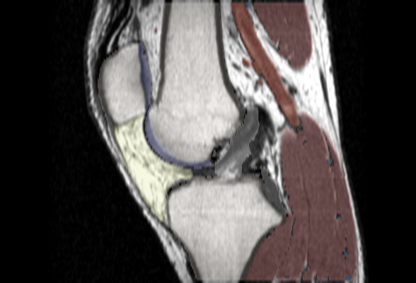 Sagittal knee MRI with color anatomy labels