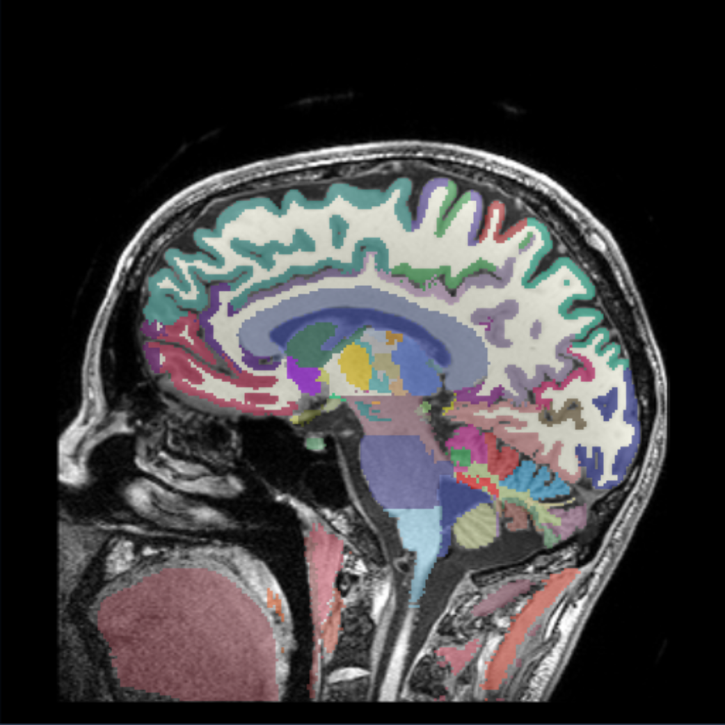 Sagittal MRI of the brain